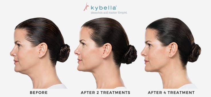 kybella-treatment-progression-photo