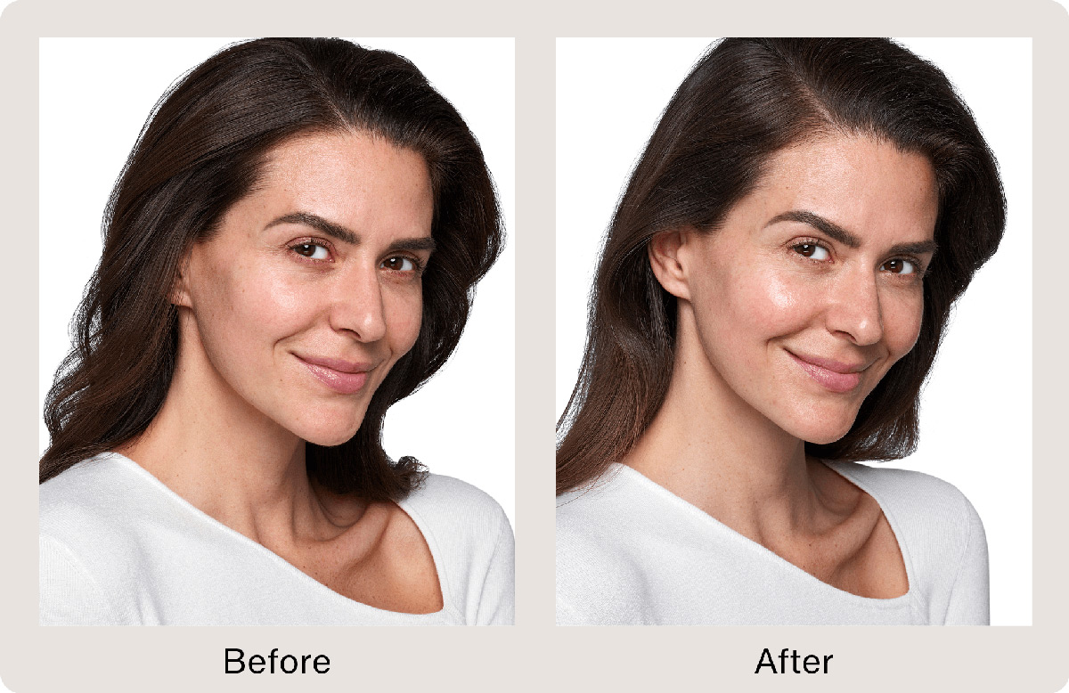 skinvive by juvederm before and after picture